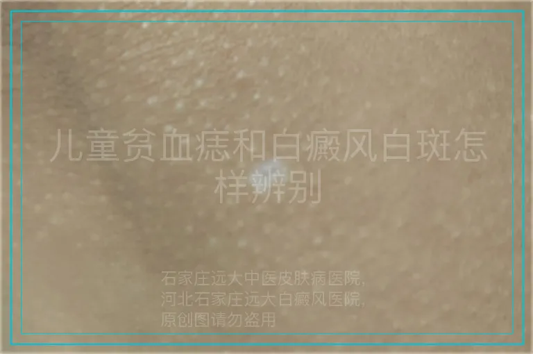 儿童贫血痣和白癜风白斑怎样辨别