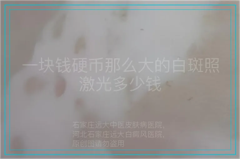 一块钱硬币那么大的白斑照激光多少钱