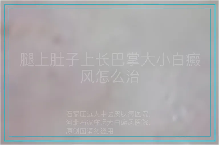 腿上肚子上长巴掌大小白癜风怎么治