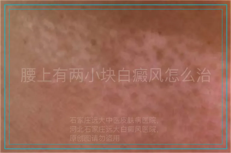 腰上有两小块白癜风怎么治