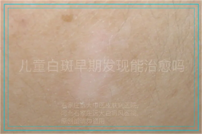 儿童白斑早期发现能治愈吗