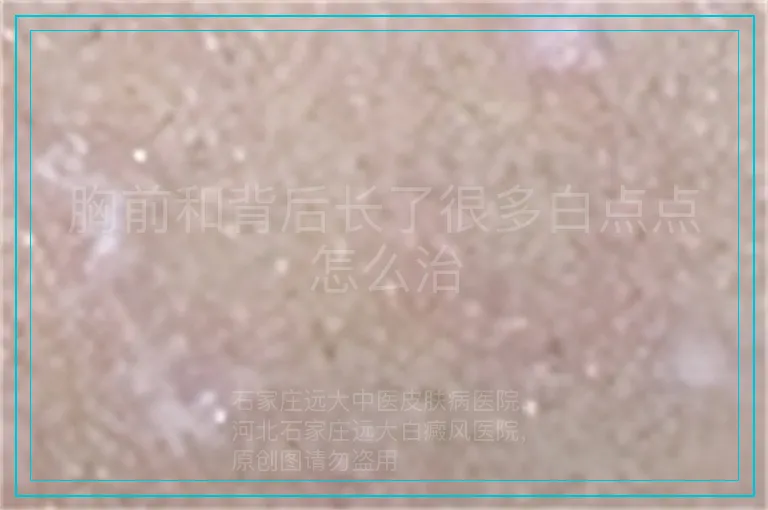 胸前和背后长了很多白点点怎么治