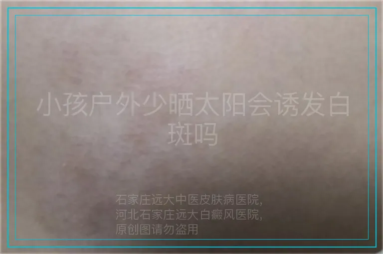 小孩户外少晒太阳会诱发白斑吗