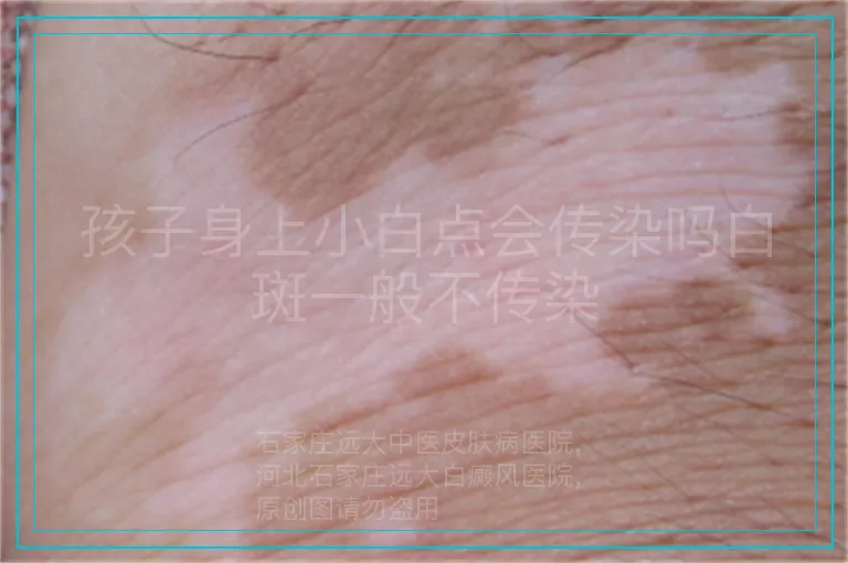 孩子身上小白点会传染吗白斑一般不传染