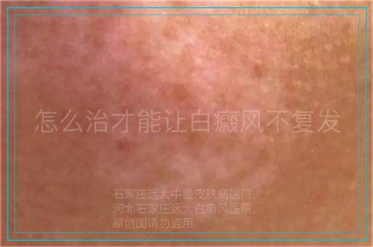 怎么治才能让白癜风不复发