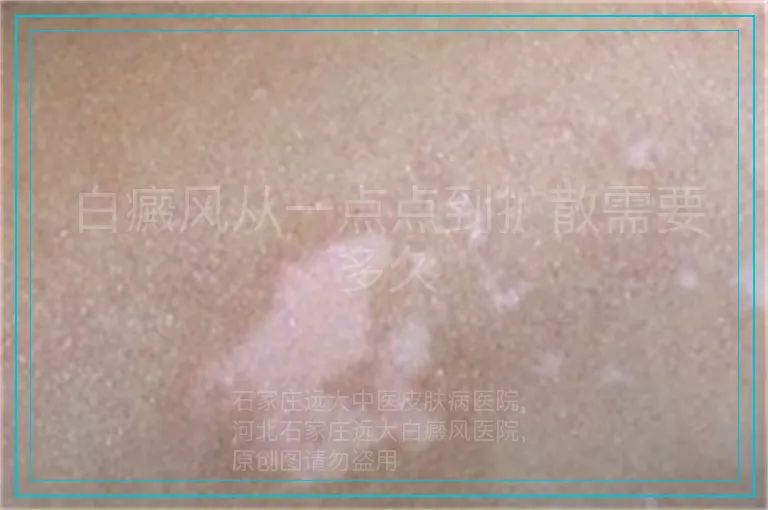 白癜风从一点点到扩散需要多久