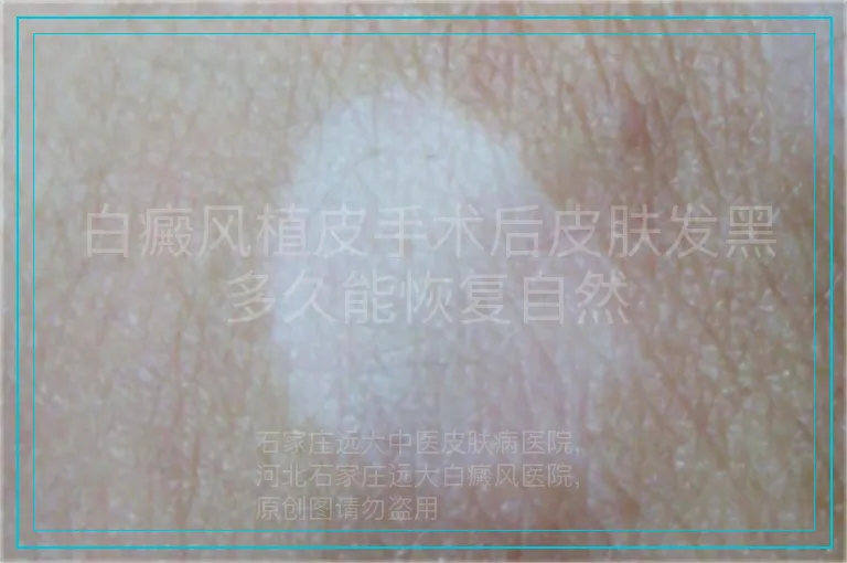 白癜风植皮手术后皮肤发黑多久能恢复自然
