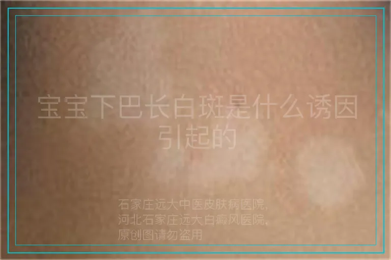 宝宝下巴长白斑是什么诱因引起的