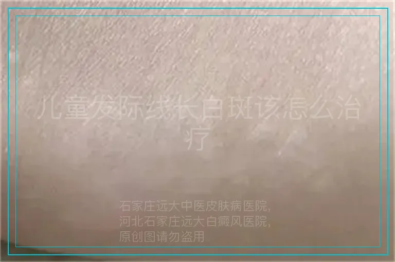 儿童发际线长白斑该怎么治疗