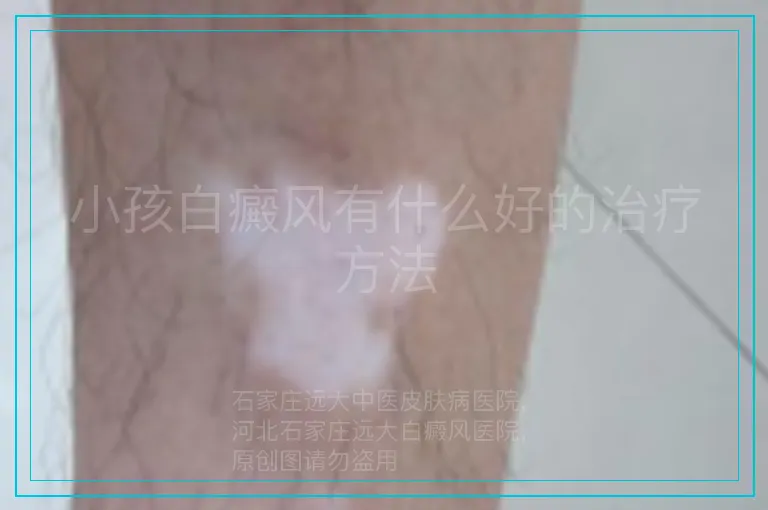 小孩白癜风有什么好的治疗方法
