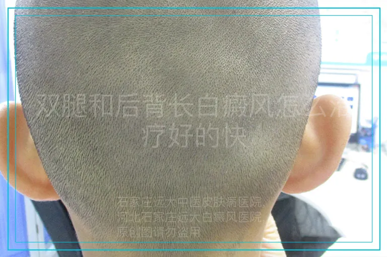双腿和后背长白癜风怎么治疗好的快