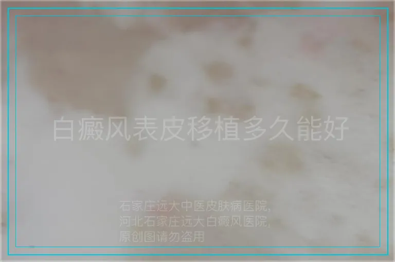 白癜风表皮移植多久能好