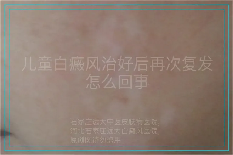 儿童白癜风治好后再次复发怎么回事