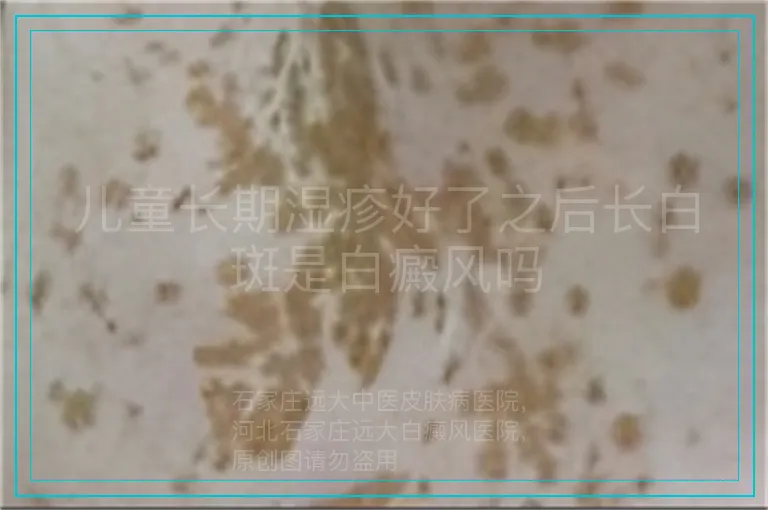 儿童长期湿疹好了之后长白斑是白癜风吗