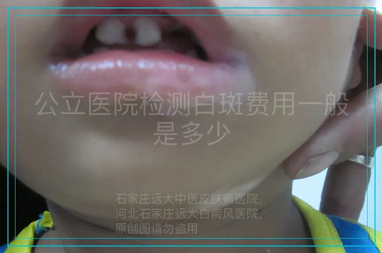 公立医院检测白斑费用一般是多少