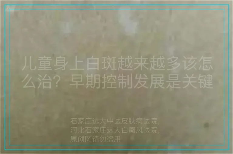 儿童身上白斑越来越多该怎么治?早期控制发展是关键