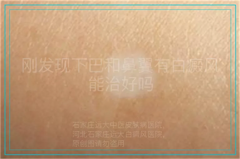 刚发现下巴和鼻翼有白癜风能治好吗