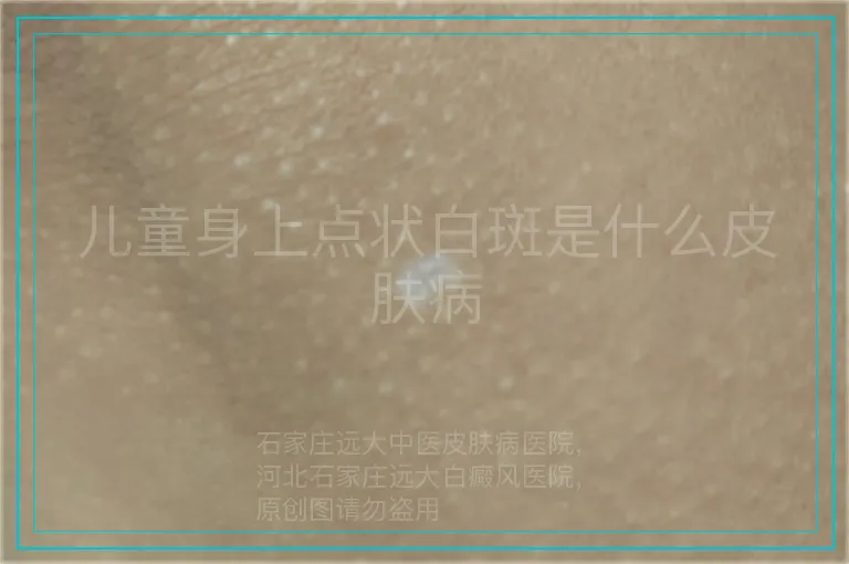 儿童身上点状白斑是什么皮肤病