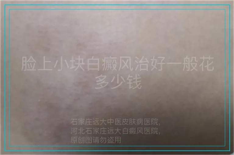 脸上小块白癜风治好一般花多少钱