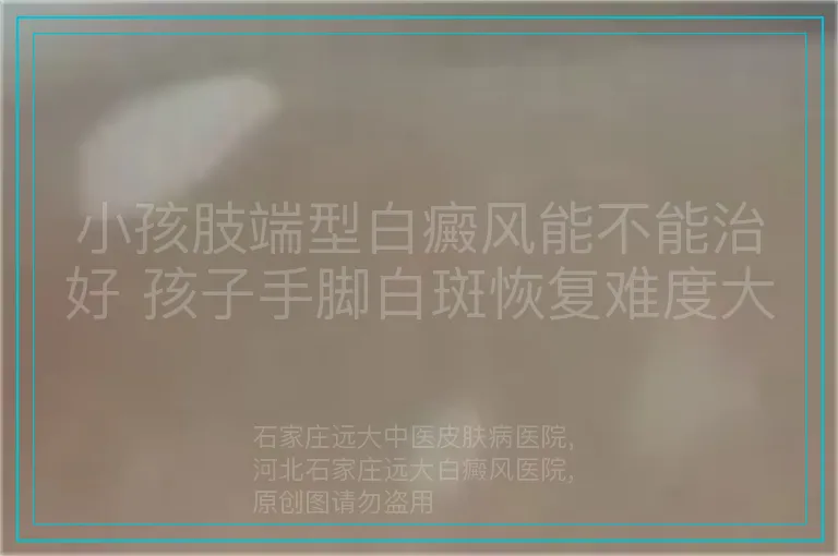 小孩肢端型白癜风能不能治好 孩子手脚白斑恢复难度大吗