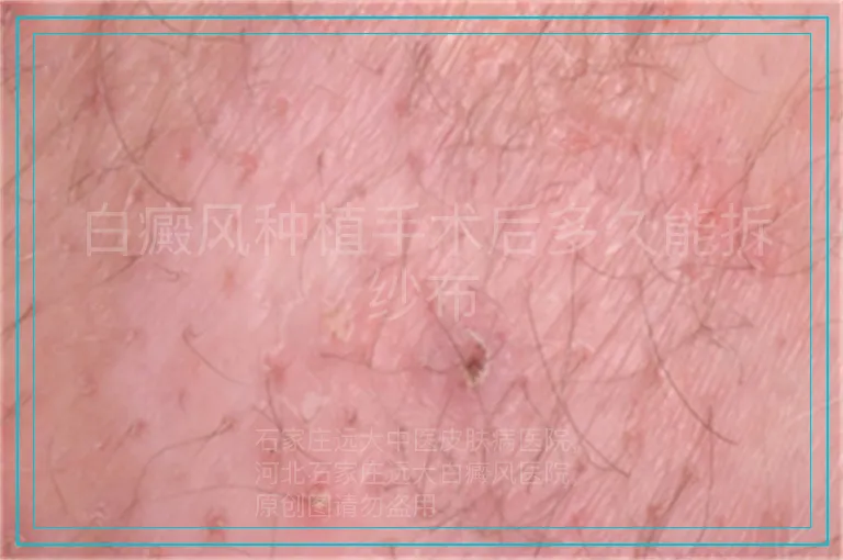 白癜风种植手术后多久能拆纱布
