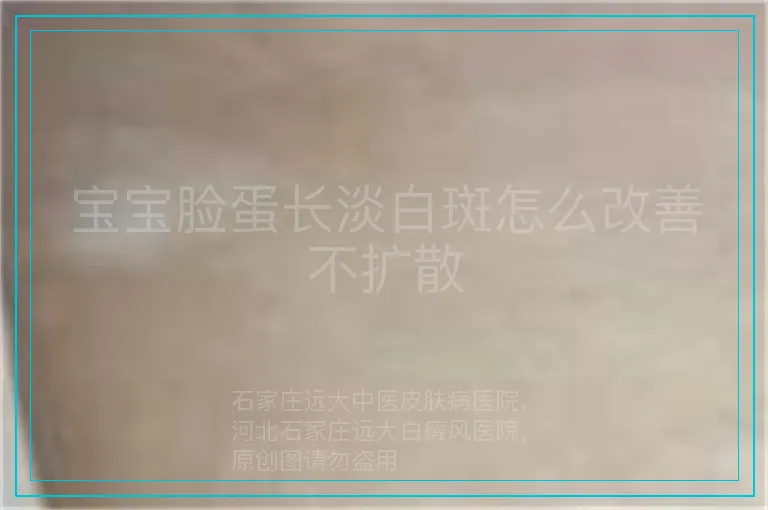 宝宝脸蛋长淡白斑怎么改善不扩散