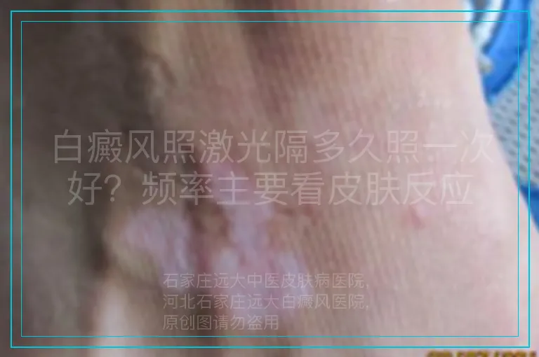 白癜风照激光隔多久照一次好?频率主要看皮肤反应
