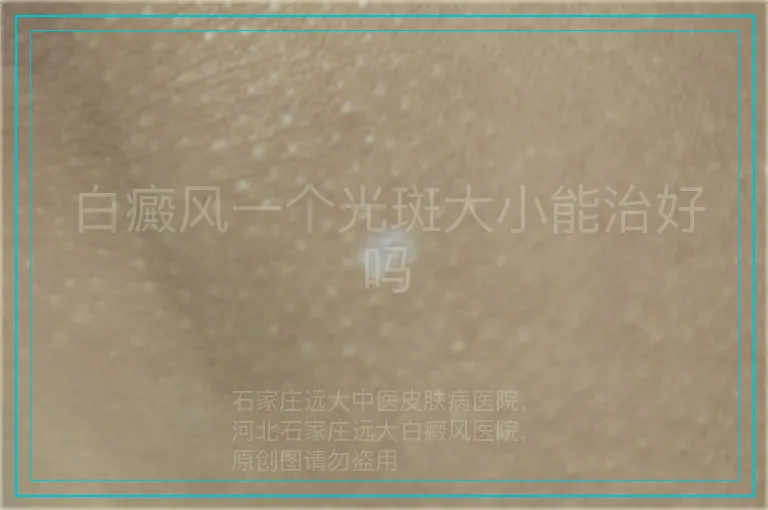 白癜风一个光斑大小能治好吗