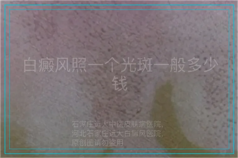 白癜风照一个光斑一般多少钱