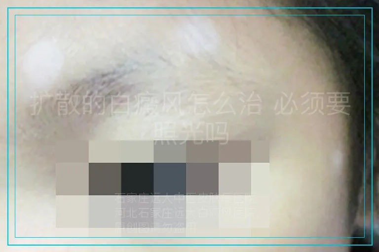 扩散的白癜风怎么治 必须要照光吗