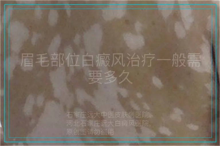 眉毛部位白癜风治疗一般需要多久