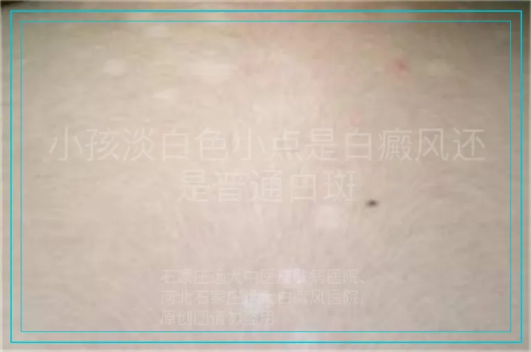 小孩淡白色小点是白癜风还是普通白斑