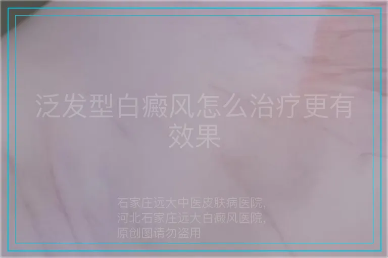泛发型白癜风怎么治疗更有效果