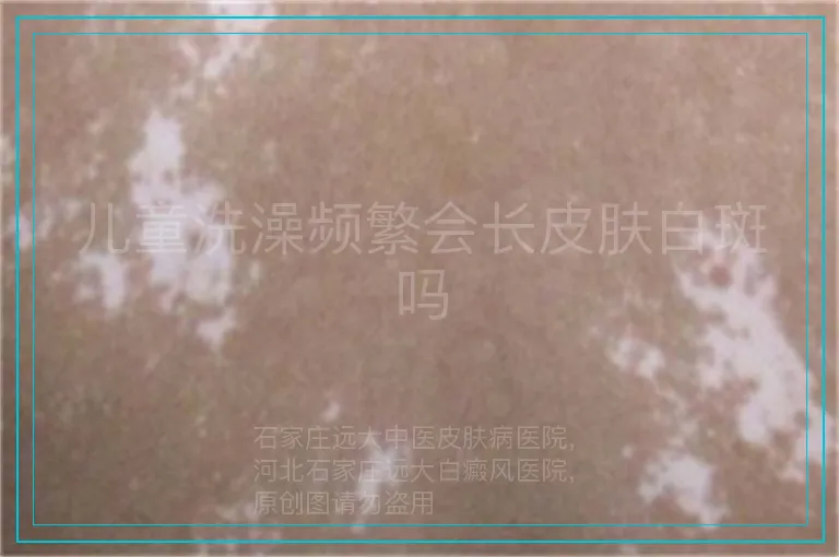 儿童洗澡频繁会长皮肤白斑吗