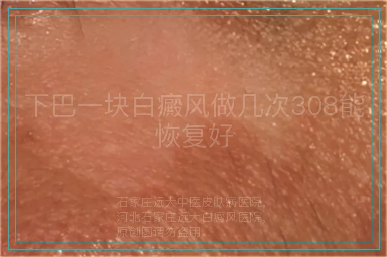 下巴一块白癜风做几次308能恢复好