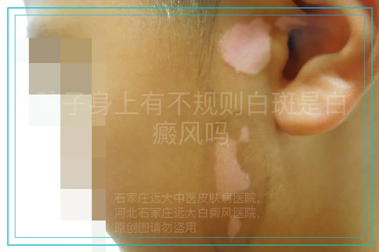 孩子身上有不规则白斑是白癜风吗