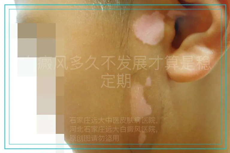 白癜风多久不发展才算是稳定期