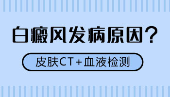 石家庄白癜风医院能给小孩治白癜风吗